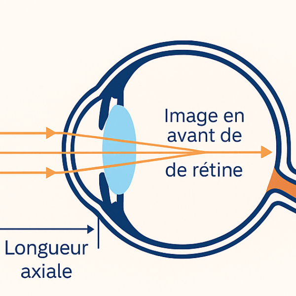 Oeil myope